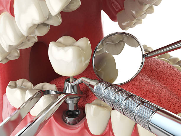 Best Dental Abscess Treatment in Aetna Estates, CO